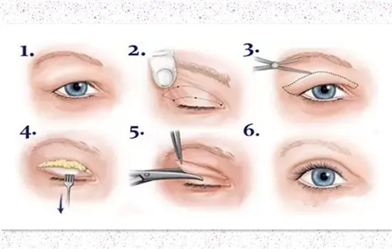 双眼皮切开法优缺点 割双眼皮不可不知的干货
