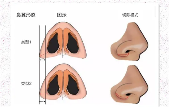 鼻翼缩小安全吗 缩鼻翼术前术后保证这4点更安全