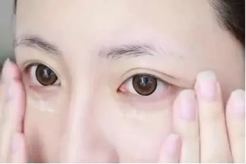 如何预防眼部皱纹 眼部皱纹形成的原因