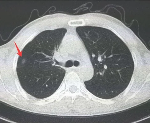 肺结节跟肺结核有什么区别