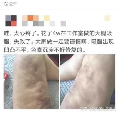 抽脂肪对身体有什么后遗症