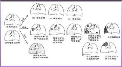 原发性肺结核的解剖病理表现是什么