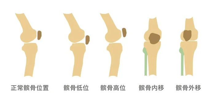 髌骨软骨软化是怎么造成的,髌骨软骨软化的原因有哪些