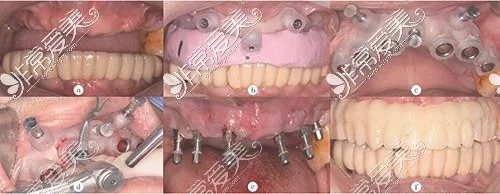 2、在种植牙的过程中不会有任何疼痛，在口腔内种植患者也不会有牙周病的出现，且不需要摘除牙颌系统。
