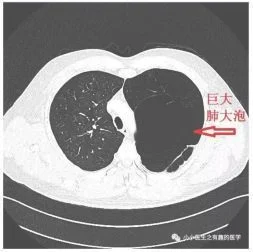 肺上有肺大泡是怎么回事？如何治疗和预防？