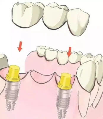 二、镶牙和种植牙