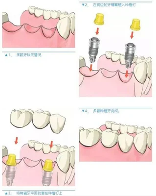 四、种植牙。