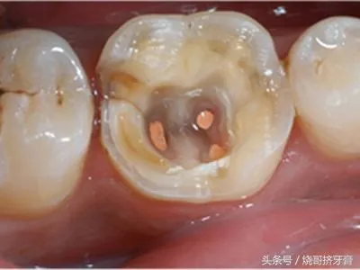 牙齿做根管治疗到底有多恐怖？