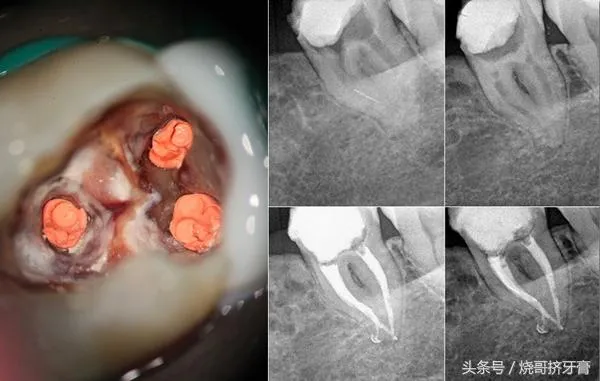 牙齿做根管治疗到底有多恐怖？