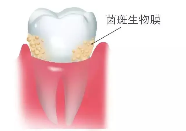 牙线是什么东西，经常用牙线好吗