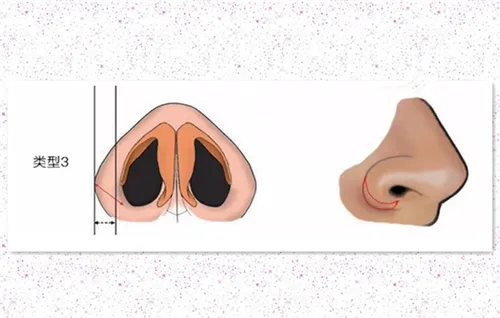 鼻翼缩小安全吗 缩鼻翼术前术后保证这4点更安全