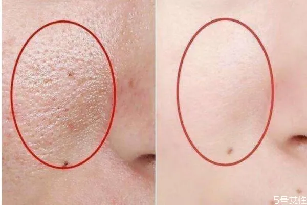 皮肤毛孔粗大的原因 为什么皮肤毛孔会粗大