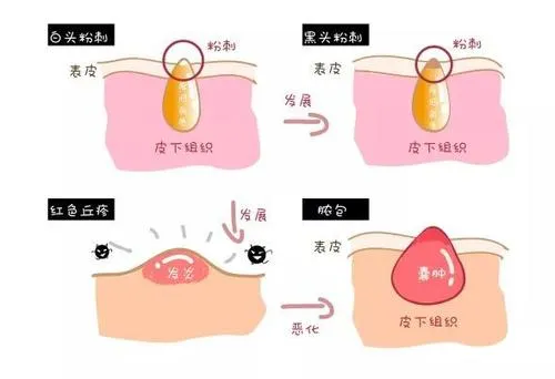 适合长脂肪粒用的眼霜 长脂肪粒适合用什么护肤品