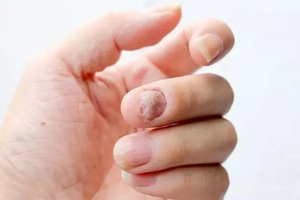 手指甲分层是怎么回事 有这些常见元凶
